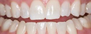 Allentown Teeth Whitening