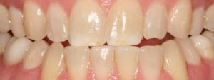 Allentown Teeth Whitening